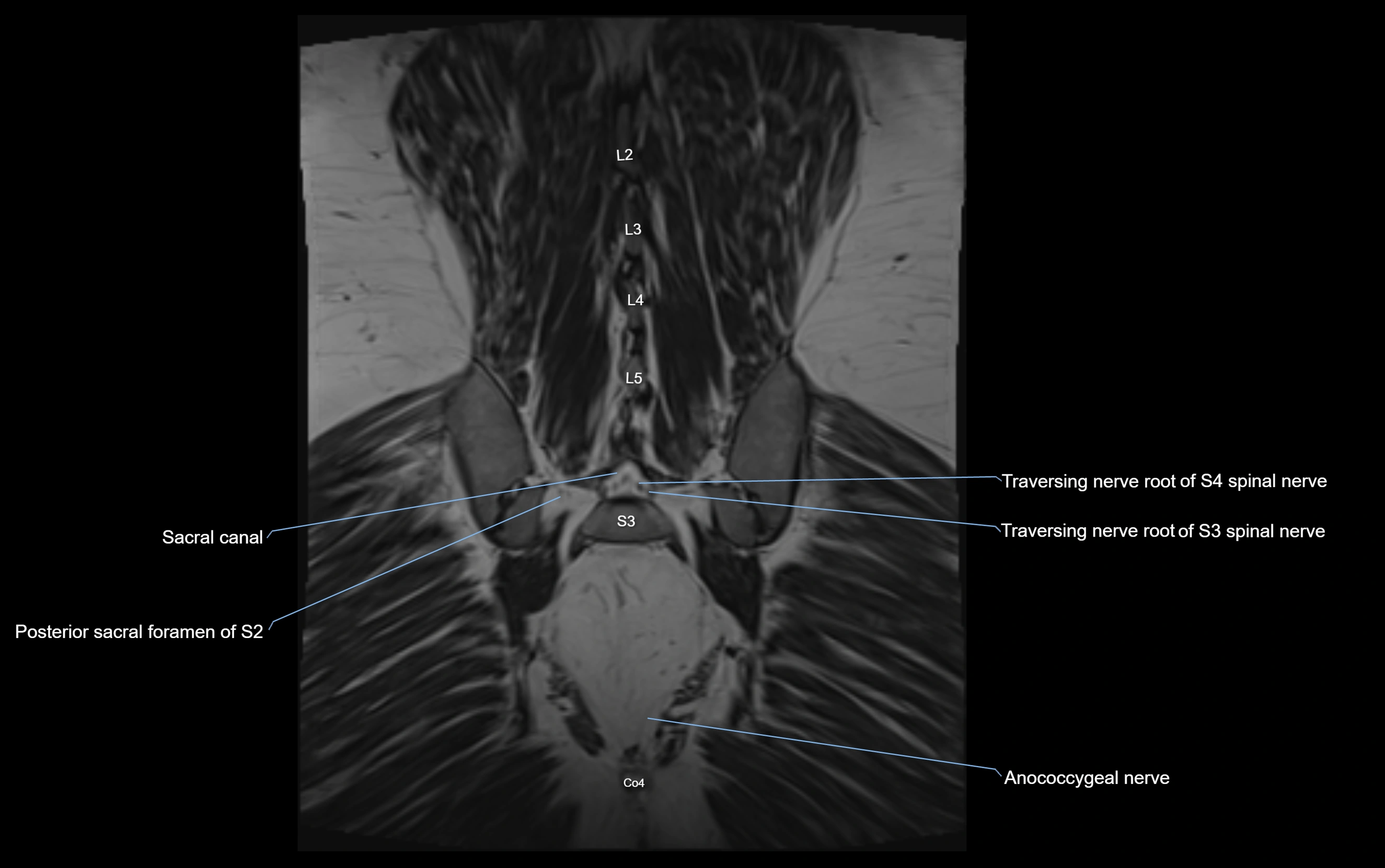 MR lumbosacral plexus cross sectional anatomy 3T  radiology  image-img-09001-00068.webp